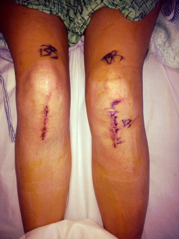 Double Knee Surgery- Osteotomy and hardware removal